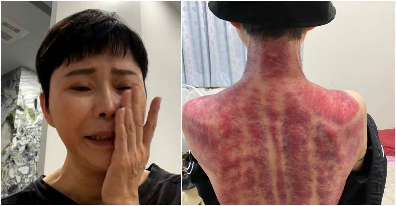 觸目驚心！56歲詹雅雯突曬「滿背血痕照」粉絲全嚇壞　悲曝近況「我挺不住了」淚喊：該設停損點
